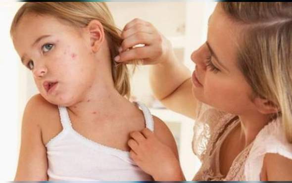 A fost confirmat al doilea caz de rujeolă în Republica Moldova. Copilul nu a fost vaccinat
